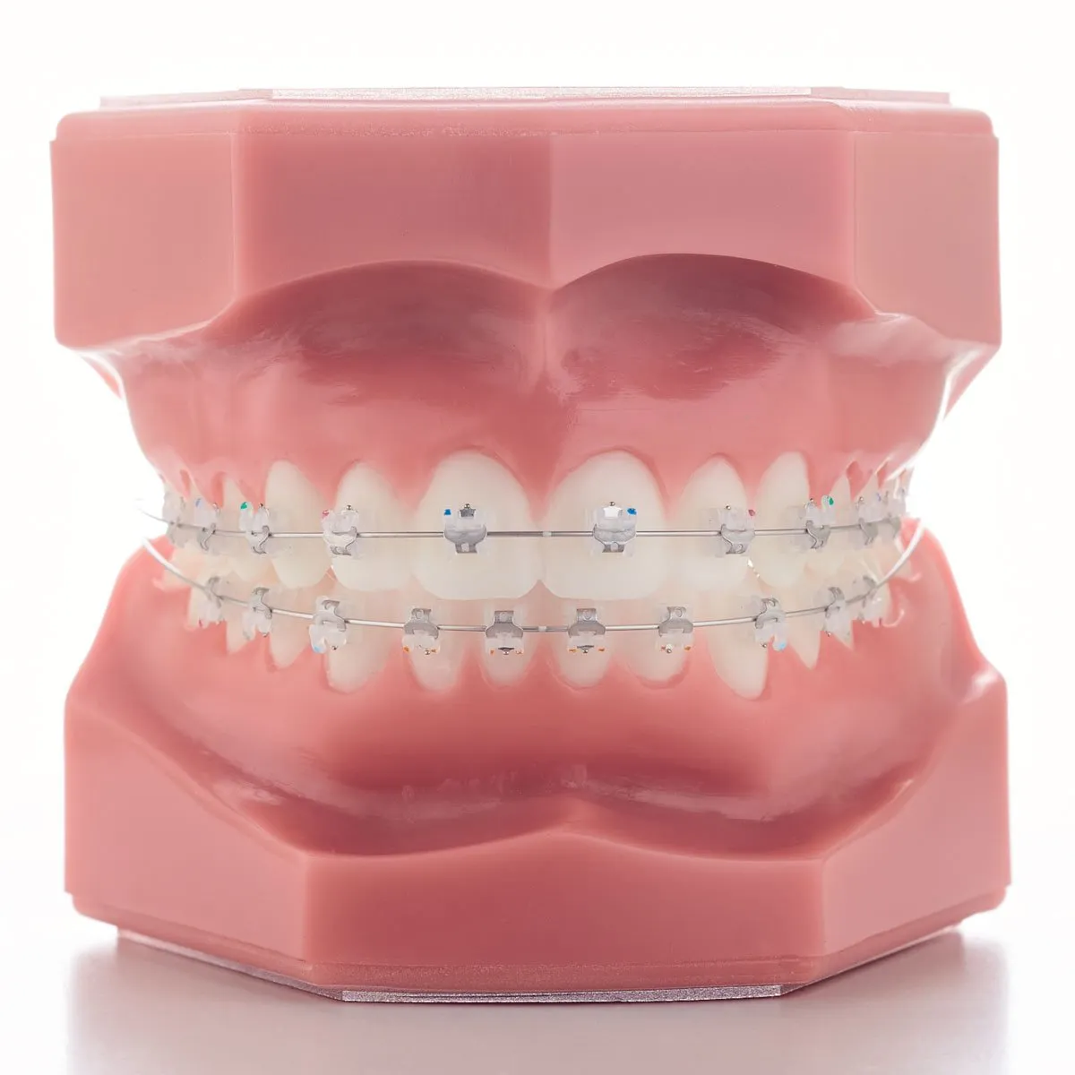 Keramikiniai beligatūriniai breketai