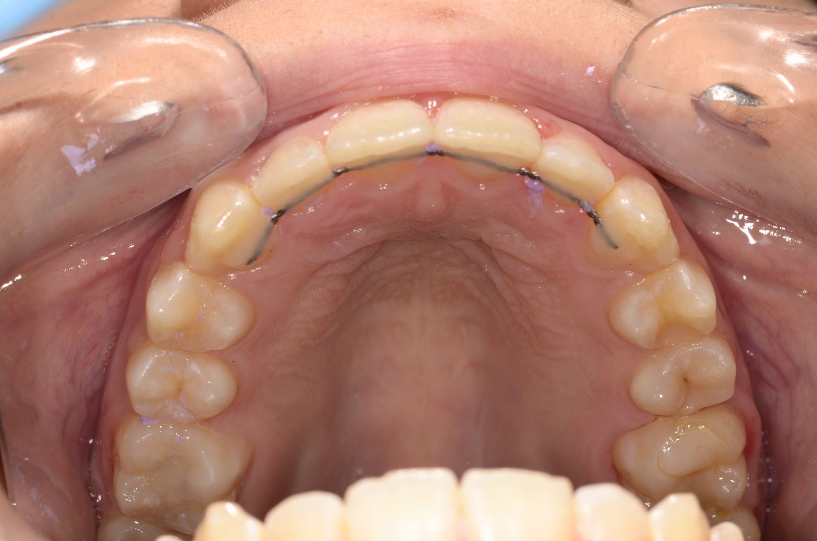 Retencija — rezultato užlaikymas