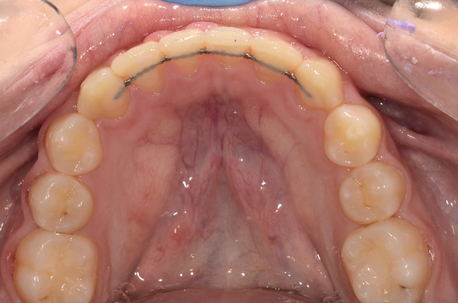 Retencija — rezultato užlaikymas