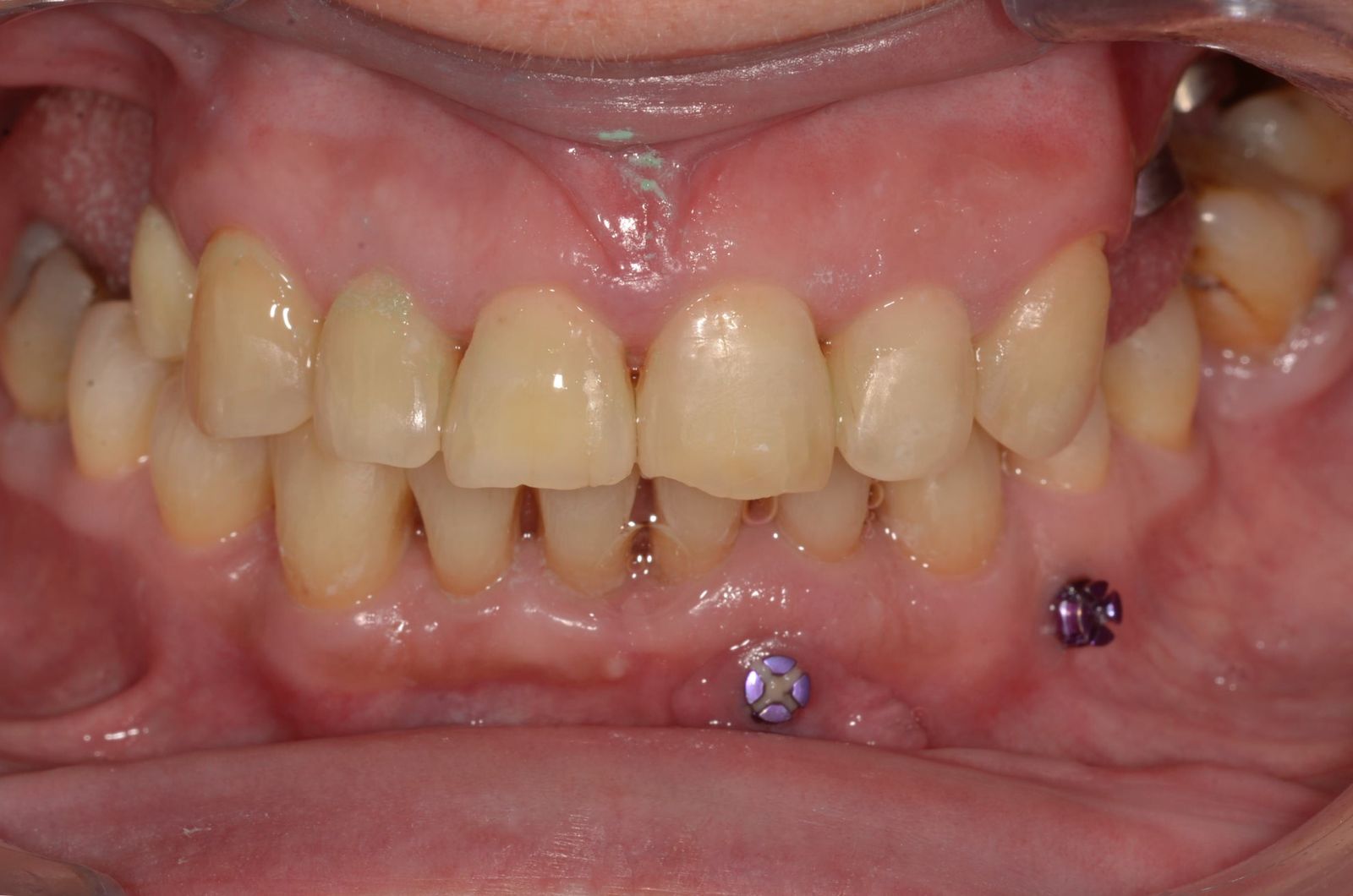 Suaugusiųjų ortodontinis gydymas